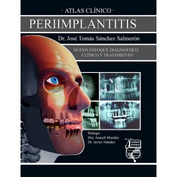 Atlas Clínico de Periimplantitis "Nuevo Enfoque Diagnóstico Clínico y Tratamiento"