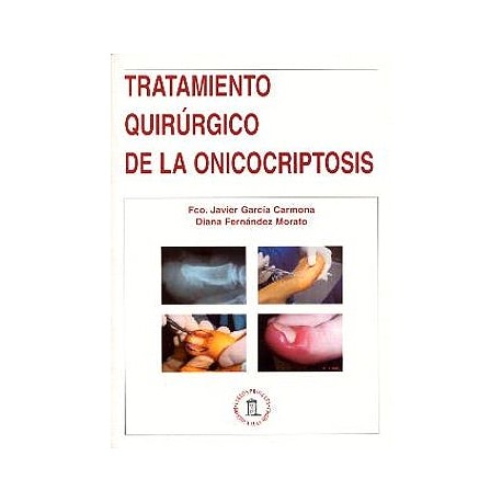 Tratamiento Quirurgico de la Onicocriptosis
