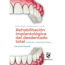 Rehabilitación Implantológica del desdentado total: Protocolo y tratamiento clínico